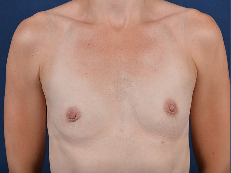 Medium Augmentation Before & After Gallery - Patient 9421954 - Image 1