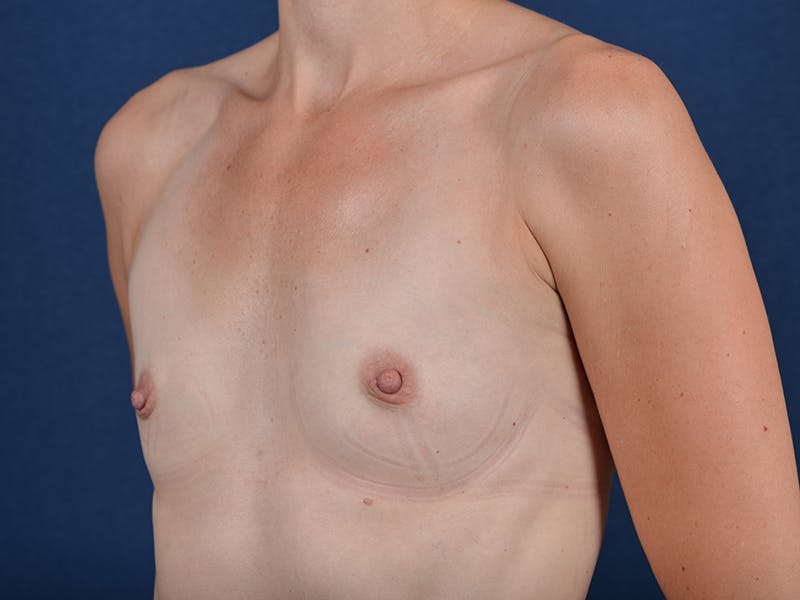Medium Augmentation Before & After Gallery - Patient 9421954 - Image 3
