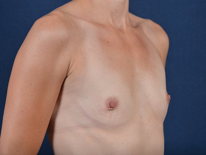 Medium Augmentation Before & After Gallery - Patient 9421954 - Image 5