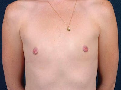 Small Augmentation Before & After Gallery - Patient 9421956 - Image 1