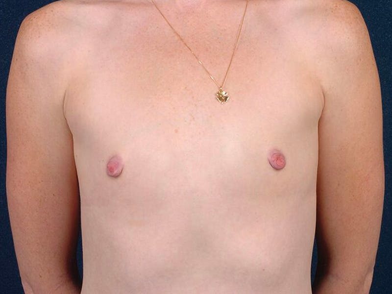 Small Augmentation Before & After Gallery - Patient 9421956 - Image 1