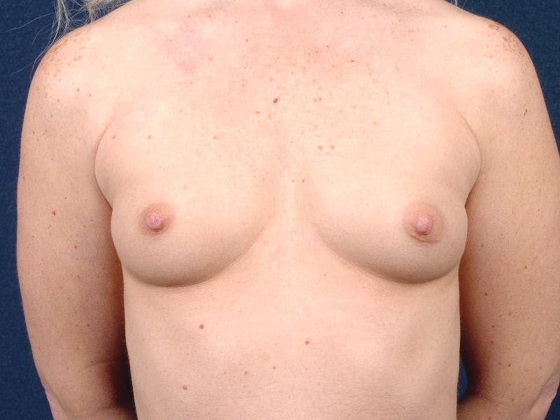 Medium Augmentation Before & After Gallery - Patient 9421957 - Image 1