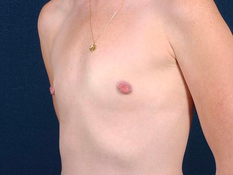 Small Augmentation Before & After Gallery - Patient 9421956 - Image 3
