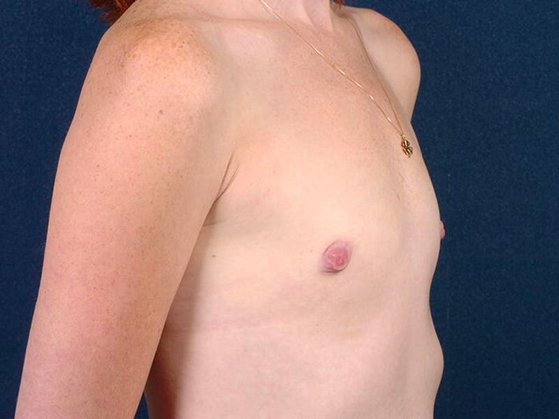 Small Augmentation Before & After Gallery - Patient 9421956 - Image 5