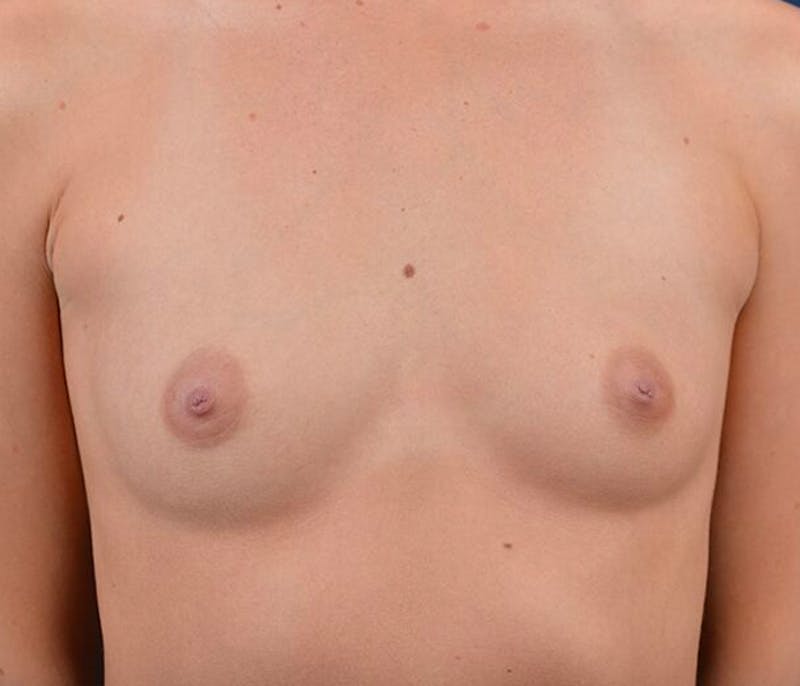 Medium Augmentation Before & After Gallery - Patient 9421961 - Image 1