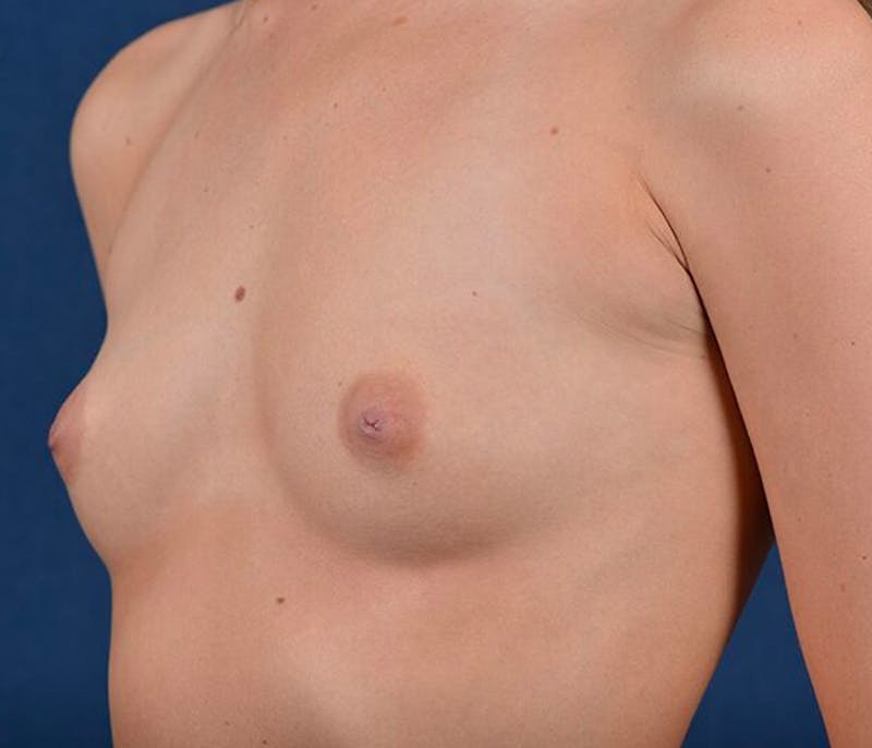 Medium Augmentation Before & After Gallery - Patient 9421961 - Image 3