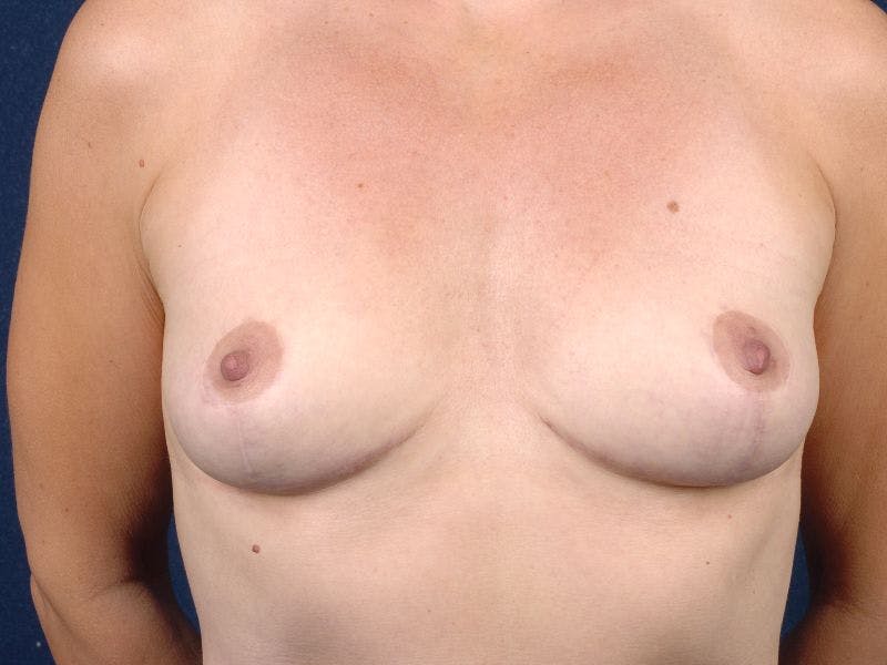 Mastopexy Before & After Gallery - Patient 9421962 - Image 2