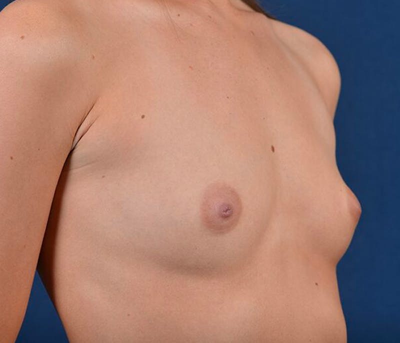 Medium Augmentation Before & After Gallery - Patient 9421961 - Image 5