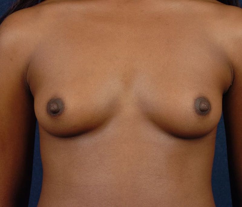 Small Augmentation Before & After Gallery - Patient 9421963 - Image 1