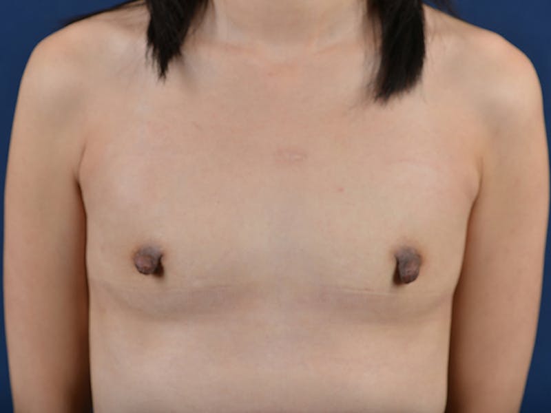 Medium Augmentation Before & After Gallery - Patient 9421966 - Image 1