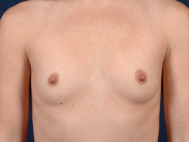 Small Augmentation Before & After Gallery - Patient 9421967 - Image 1