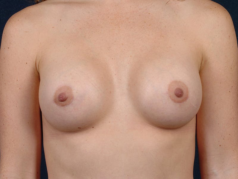 Small Augmentation Before & After Gallery - Patient 9421967 - Image 2