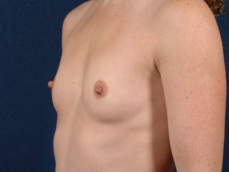 Small Augmentation Before & After Gallery - Patient 9421967 - Image 3
