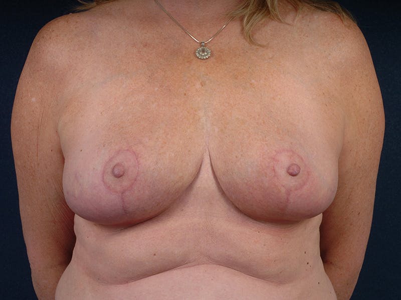 Breast Reduction Before & After Gallery - Patient 9422373 - Image 2