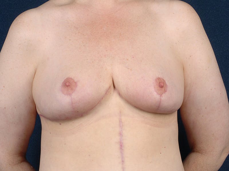 Breast Reduction Before & After Gallery - Patient 9422380 - Image 2