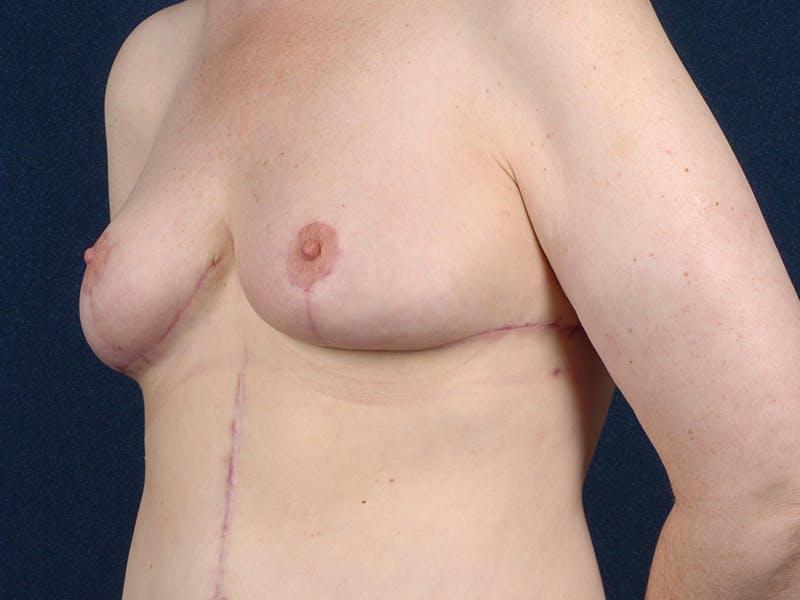 Breast Reduction Before & After Gallery - Patient 9422380 - Image 4