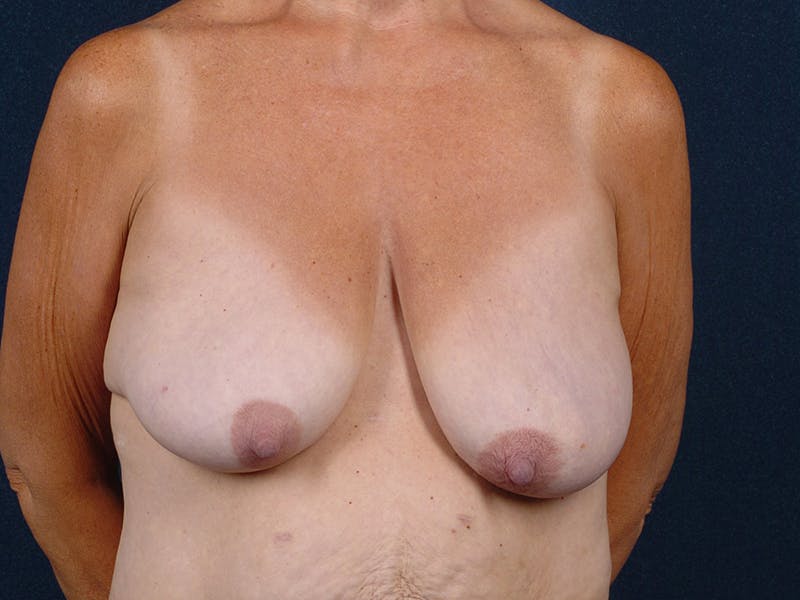 Breast Reduction Before & After Gallery - Patient 9422382 - Image 1