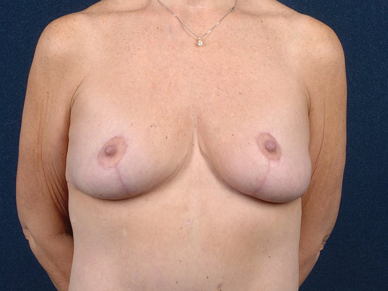 Breast Reduction Gallery - Patient 9422382 - Image 2