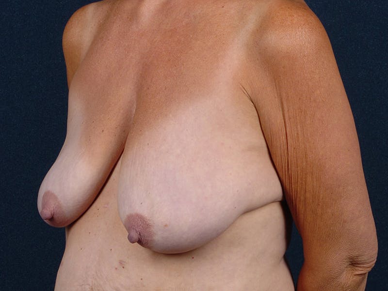 Breast Reduction Before & After Gallery - Patient 9422382 - Image 3