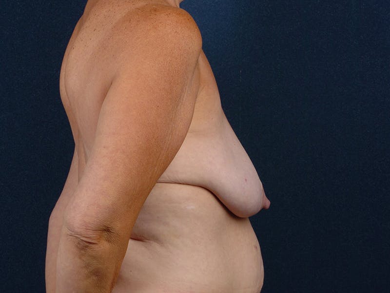 Breast Reduction Before & After Gallery - Patient 9422382 - Image 5