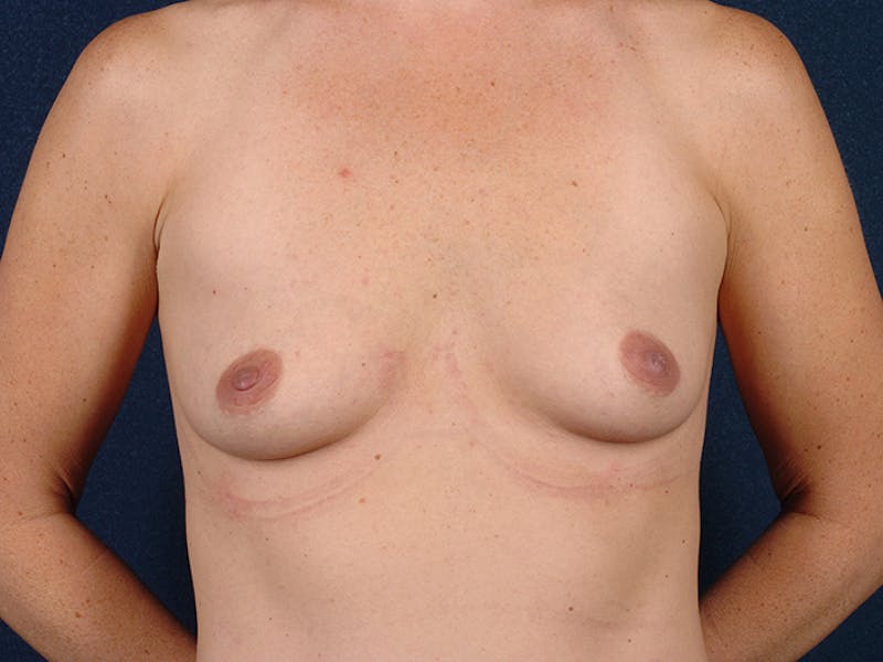 Medium Augmentation Before & After Gallery - Patient 9423800 - Image 1