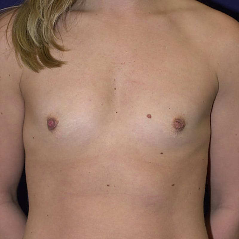 Medium Augmentation Before & After Gallery - Patient 9423807 - Image 1