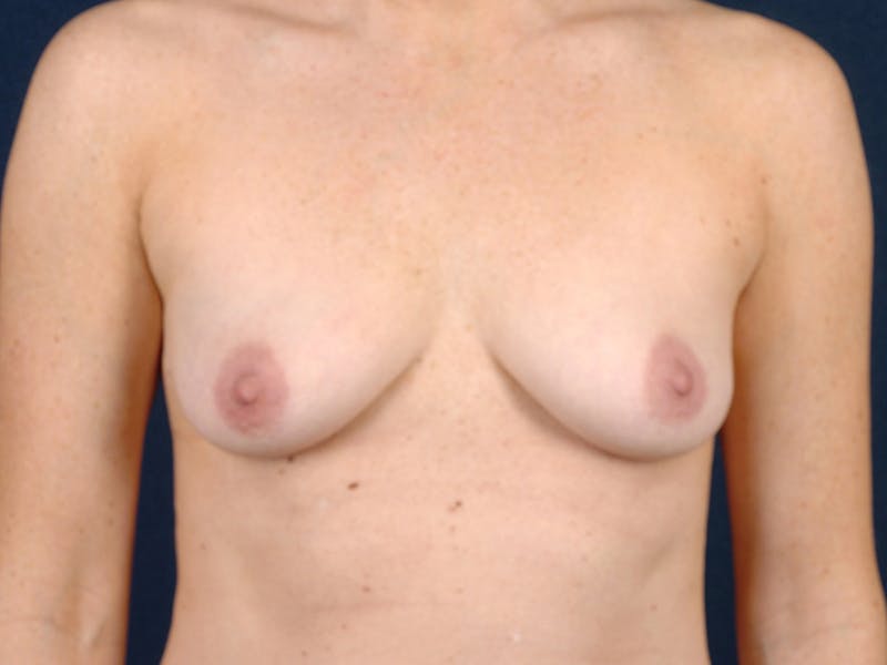 Medium Augmentation Before & After Gallery - Patient 9423818 - Image 1