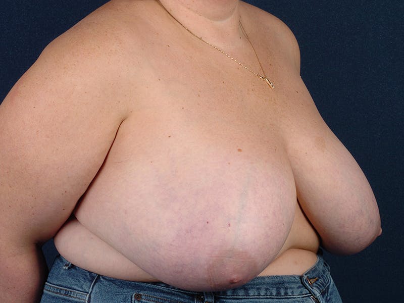 Breast Reduction Before & After Gallery - Patient 9423819 - Image 5