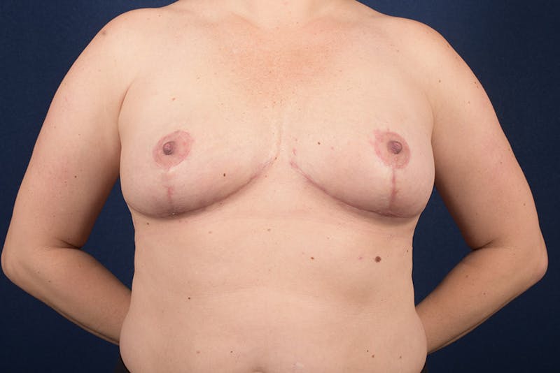 Breast Reduction Before & After Gallery - Patient 9423822 - Image 2