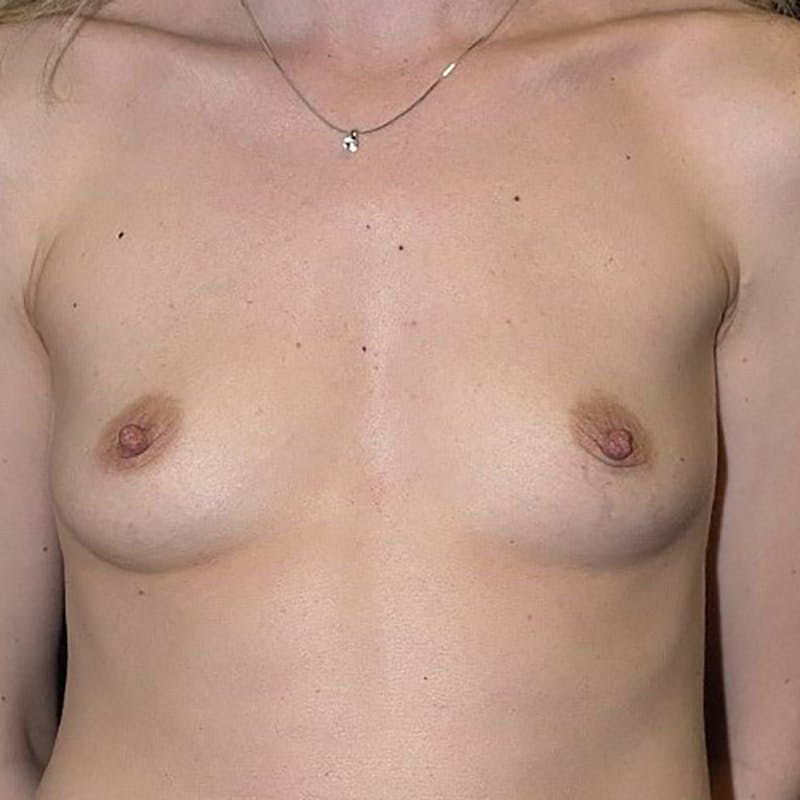 Medium Augmentation Before & After Gallery - Patient 9423823 - Image 1