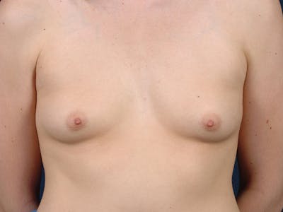 Medium Augmentation Before & After Gallery - Patient 9423840 - Image 1