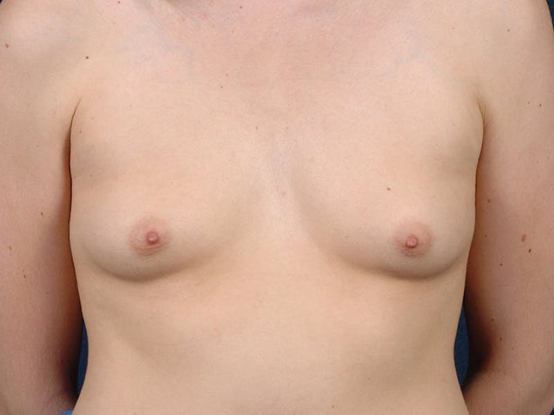 Medium Augmentation Before & After Gallery - Patient 9423840 - Image 1