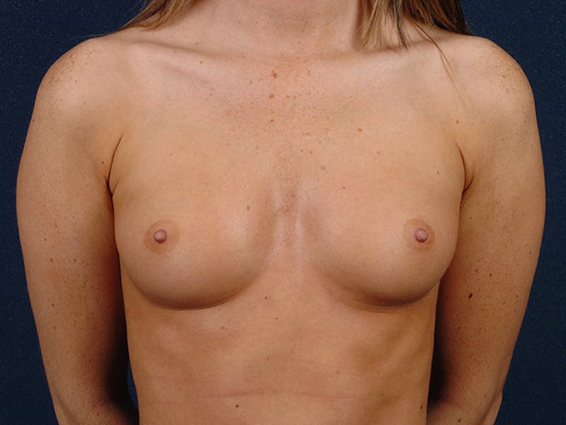 Medium Augmentation Before & After Gallery - Patient 9423845 - Image 1
