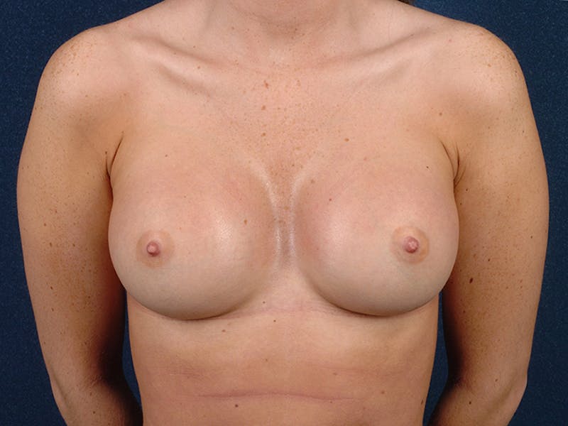 Medium Augmentation Before & After Gallery - Patient 9423845 - Image 2