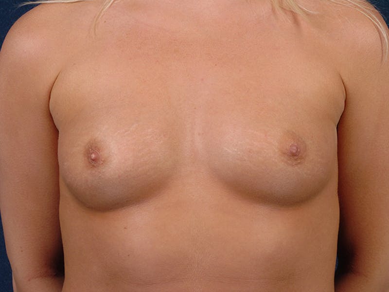 Medium Augmentation Before & After Gallery - Patient 9423945 - Image 1