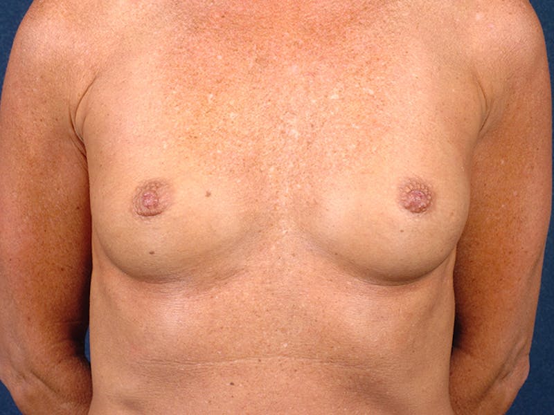 Medium Augmentation Before & After Gallery - Patient 9423947 - Image 1