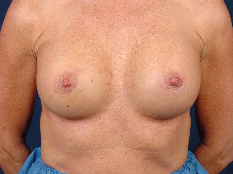 Medium Augmentation Before & After Gallery - Patient 9423947 - Image 2