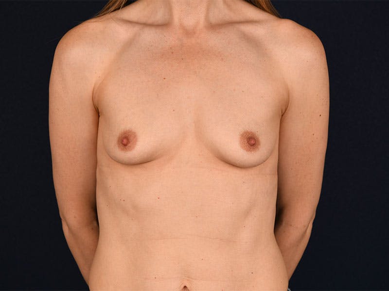 Small Augmentation Before & After Gallery - Patient 9433217 - Image 1