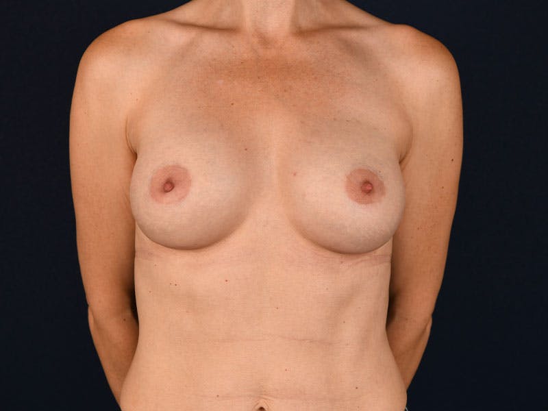 Small Augmentation Before & After Gallery - Patient 9433217 - Image 2