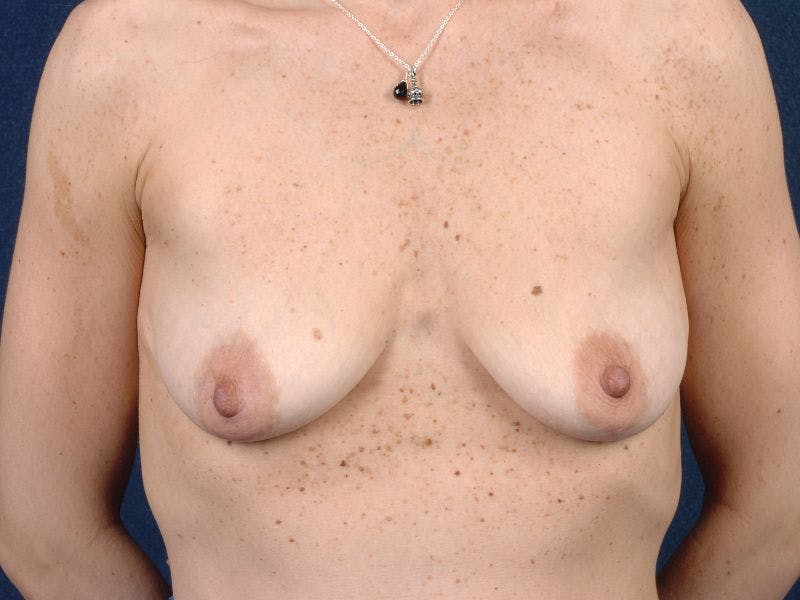 Augmentation Mastopexy Before & After Gallery - Patient 9689287 - Image 1