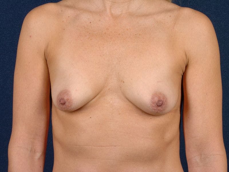Augmentation Mastopexy Before & After Gallery - Patient 9689330 - Image 1