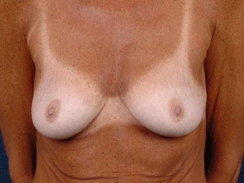 Augmentation Mastopexy Before & After Gallery - Patient 9689341 - Image 1