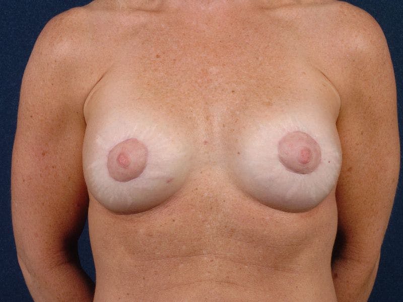Augmentation Mastopexy Before & After Gallery - Patient 9689382 - Image 2