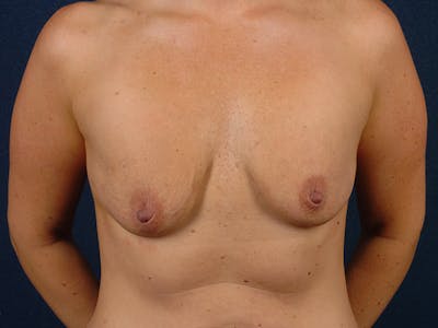 Augmentation Mastopexy Before & After Gallery - Patient 9689420 - Image 1