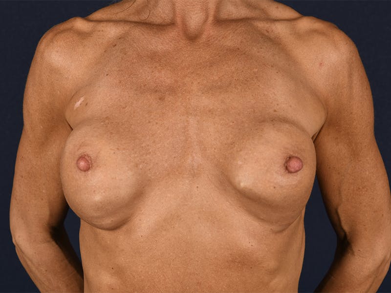 Breast Revision Before & After Gallery - Patient 9689421 - Image 1
