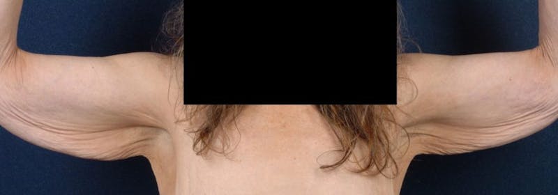 Brachioplasty Before & After Gallery - Patient 9691131 - Image 1