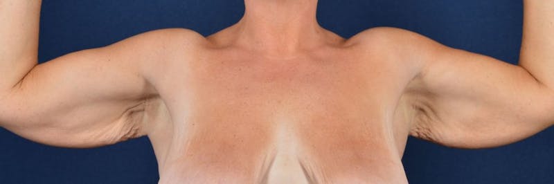 Brachioplasty Before & After Gallery - Patient 9691133 - Image 1