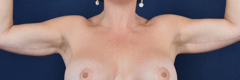Brachioplasty Before & After Gallery - Patient 9691133 - Image 2
