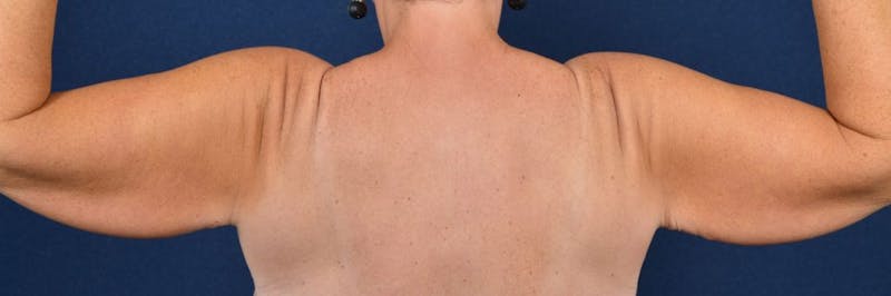 Brachioplasty Before & After Gallery - Patient 9691133 - Image 3