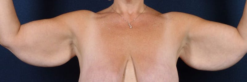 Brachioplasty Before & After Gallery - Patient 9691135 - Image 1